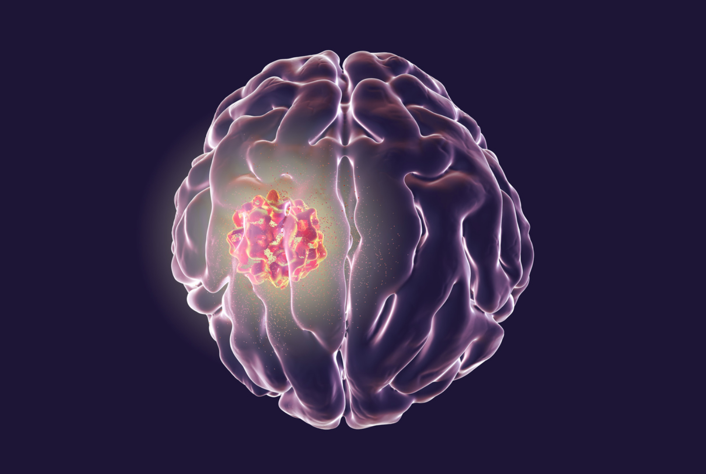 Pharmacy Clinical Pearl of the Day: Glioblastoma