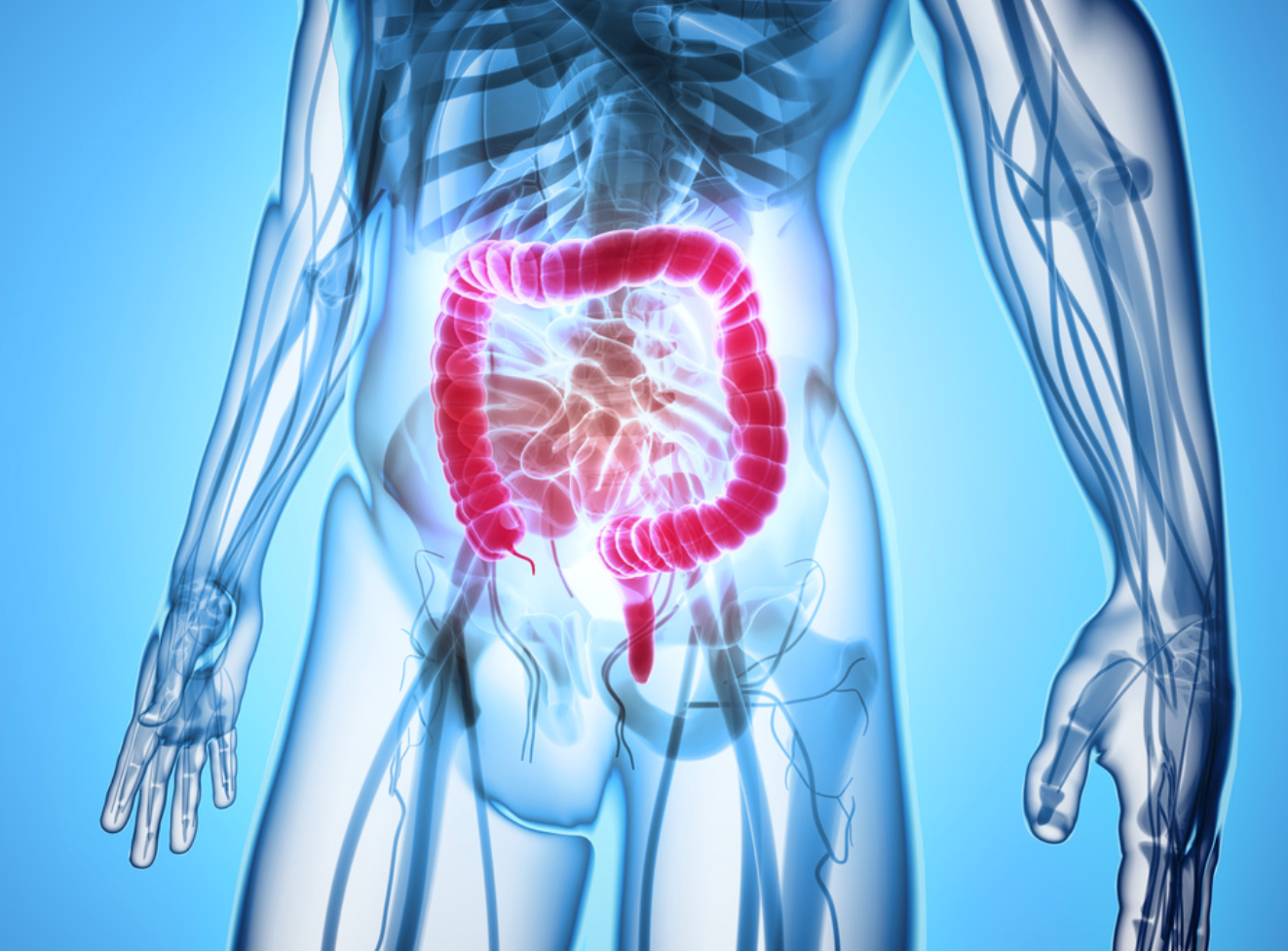 C. Difficile Infection May Activate Dormant Crohn Disease