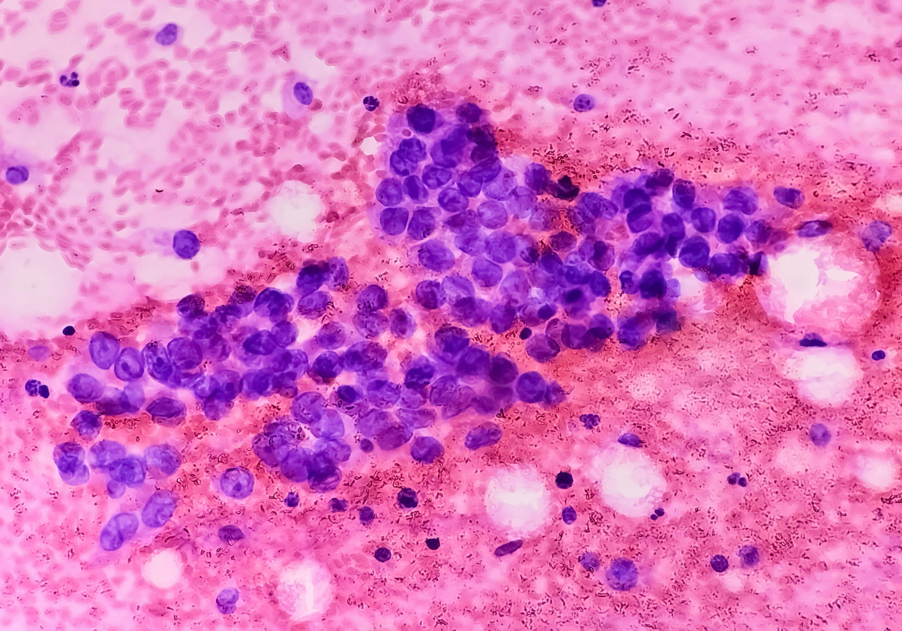 Close-up of non-small cell carcinoma in lung