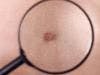 Is that a Spot? Self-Screening for Skin Cancer