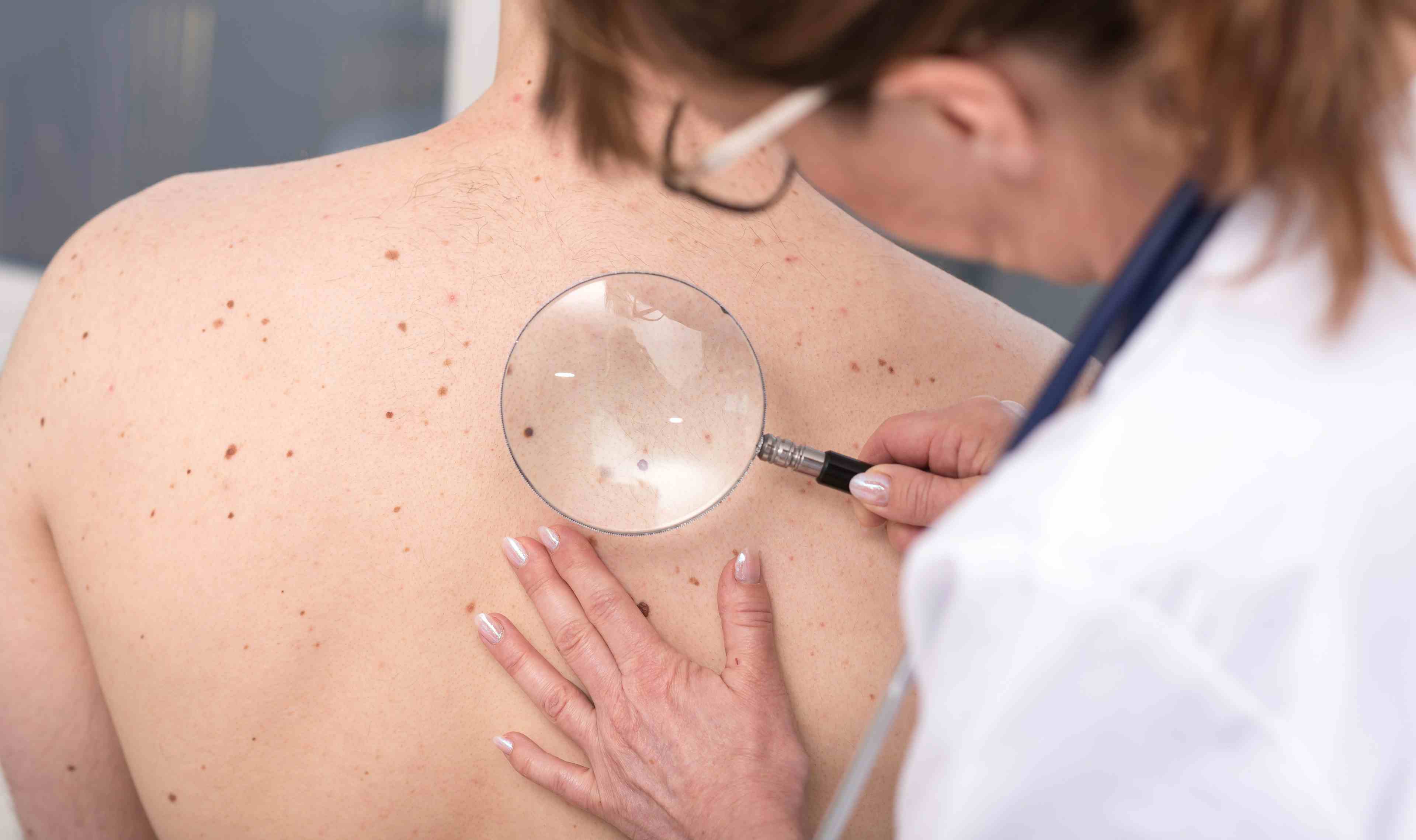 Dermatologist examining the skin of a patient | Image Credit: thodonal - stock.adobe.com