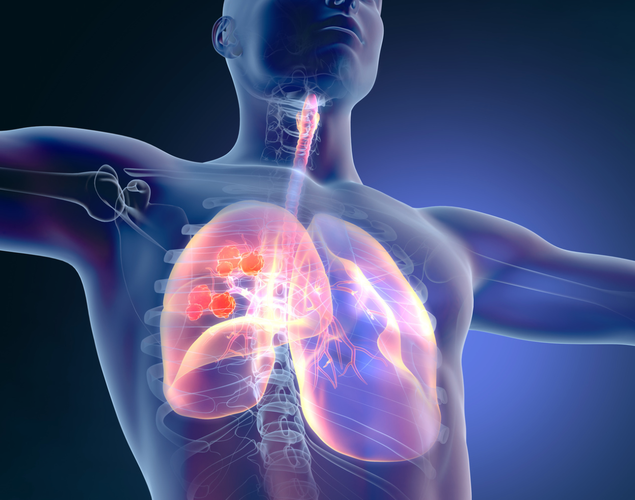 Immunotherapy Combination Improves Survival in Advanced Non-Small Cell Lung Cancer 