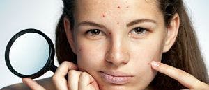 New Rosacea Foam Treatment Approved by FDA