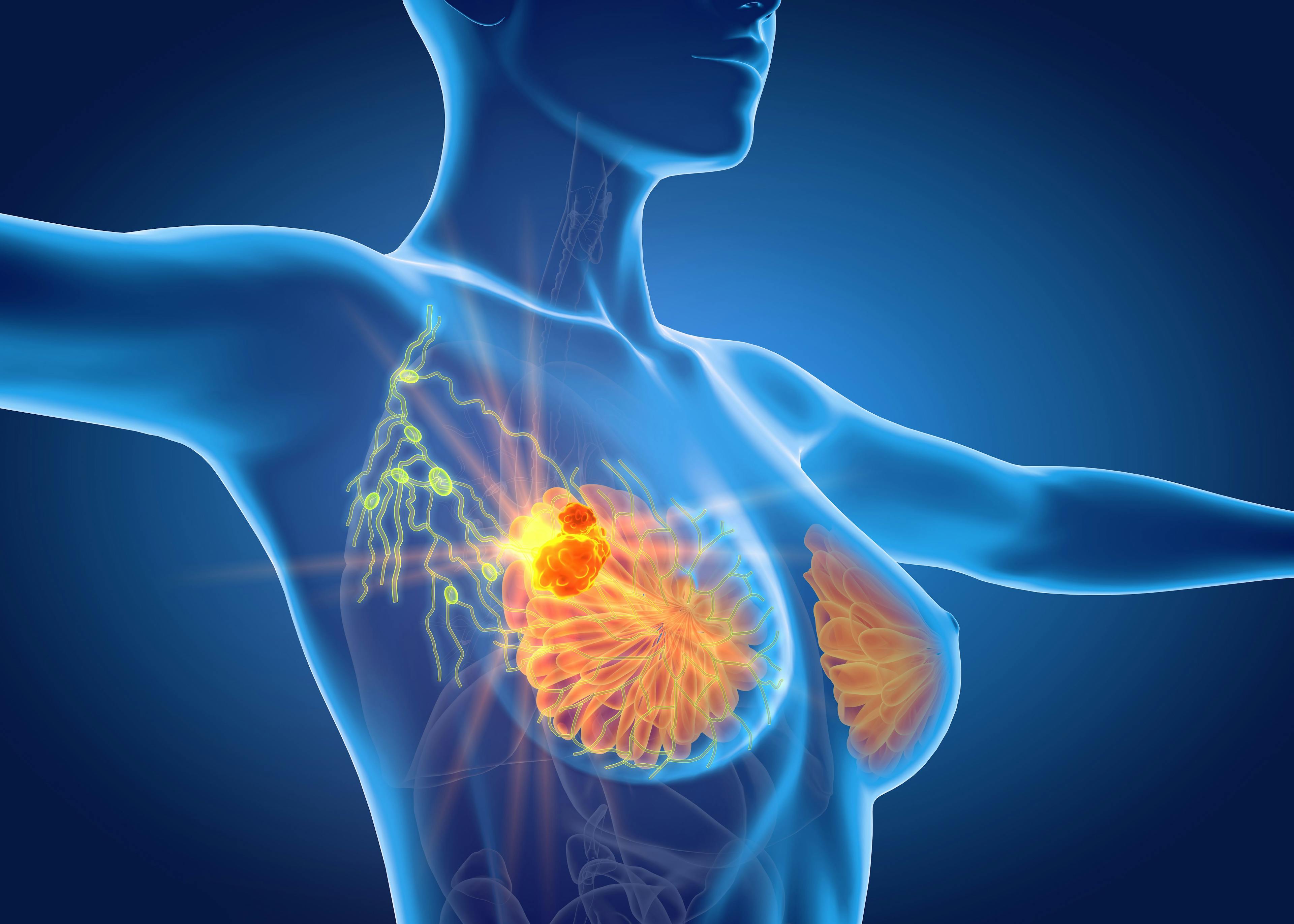 Under-Recognition of Symptoms Common in Patients With Breast Cancer
