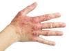Protective Protein May Improve Atopic Dermatitis Symptoms