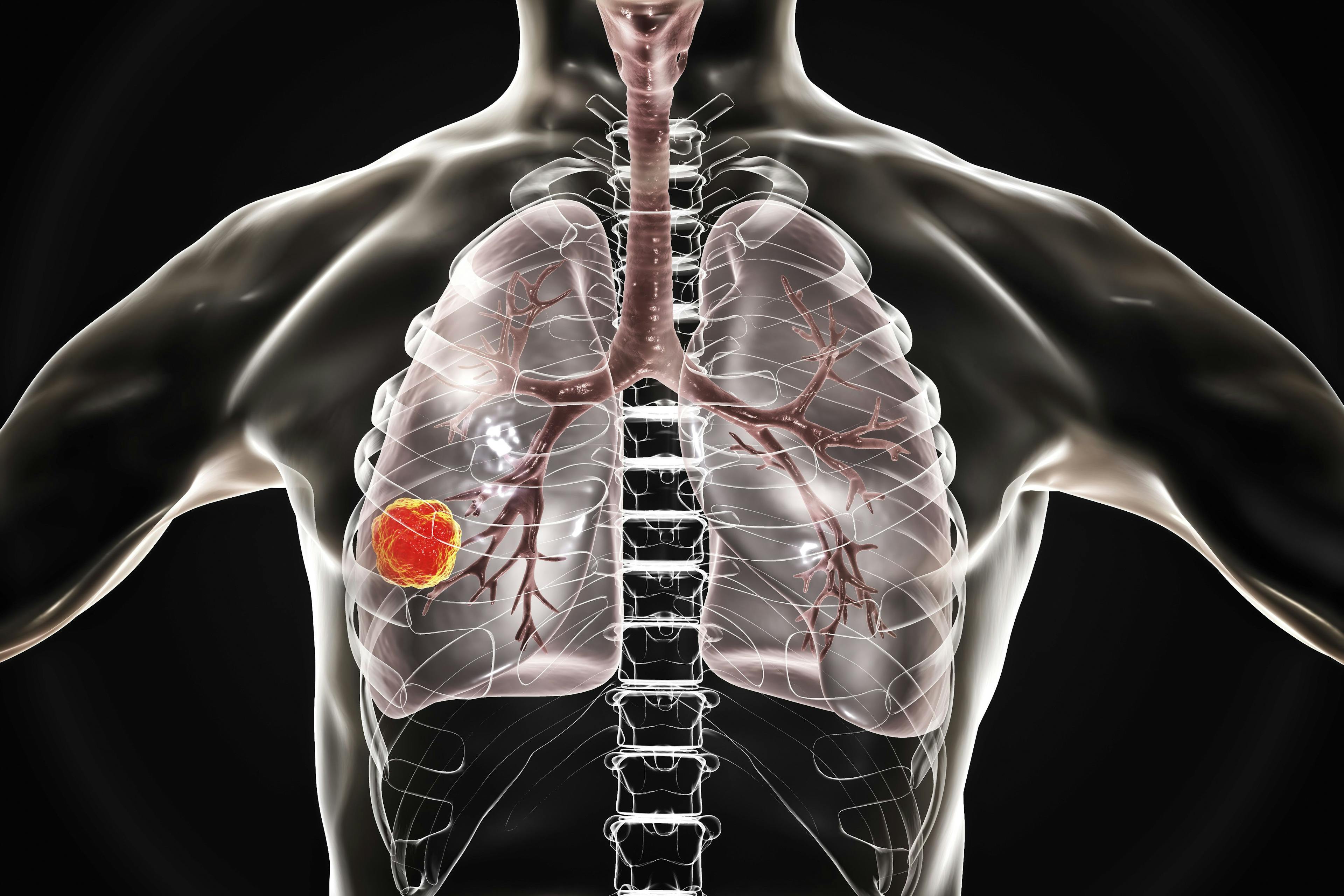 Model Predicts Non-Small Cell Lung Cancer Patient Outcomes to Immunotherapy