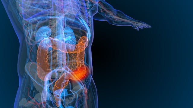 3d rendered illustration of bowel cancer 3D illustration- Image credit: Appledesign | stock.adobe.com 
