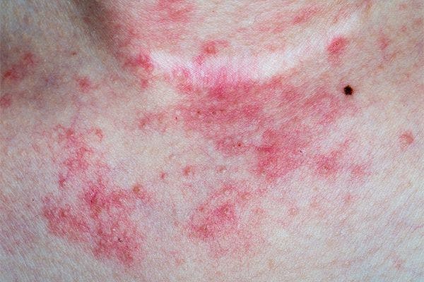 Researchers Urge Greater Awareness of Delayed Skin Reactions to Moderna COVID-19 Vaccine