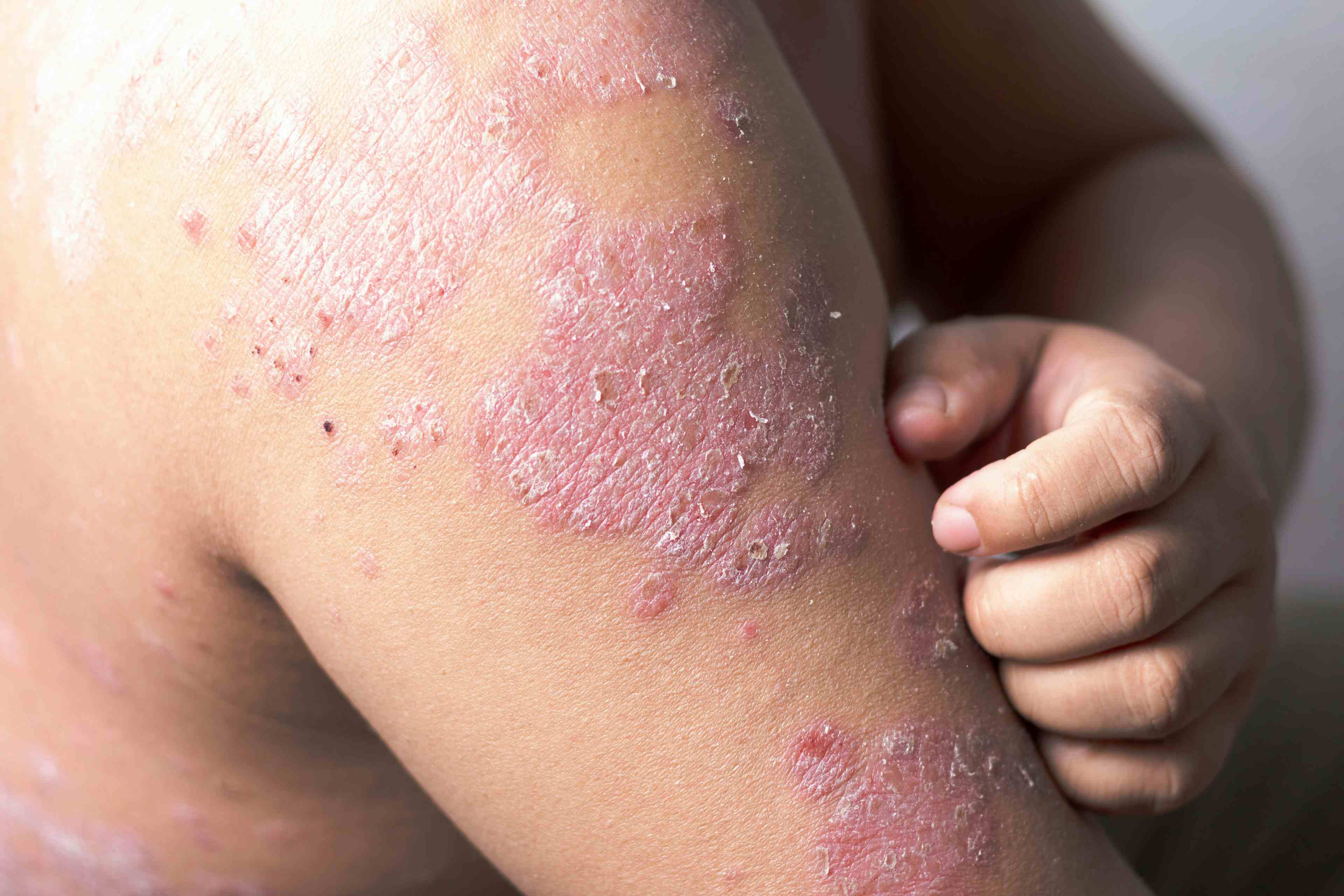 Patient suffering from atopic dermatitis -- Image credit: Nikkikii | stock.adobe.com