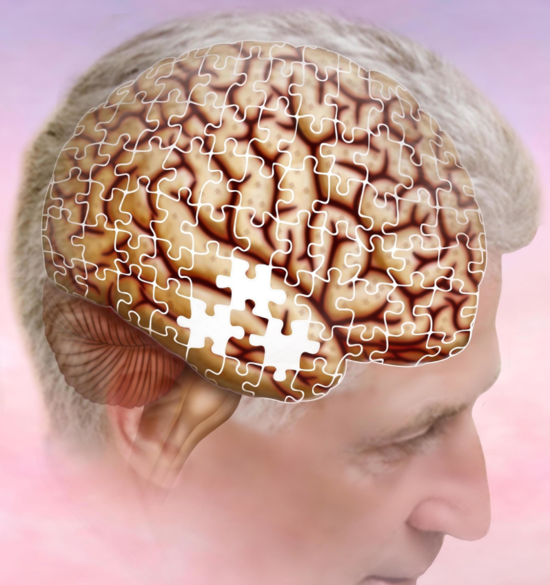 FDA Committee Does Not Recommend Approval of Aducanumab for Alzheimer Disease