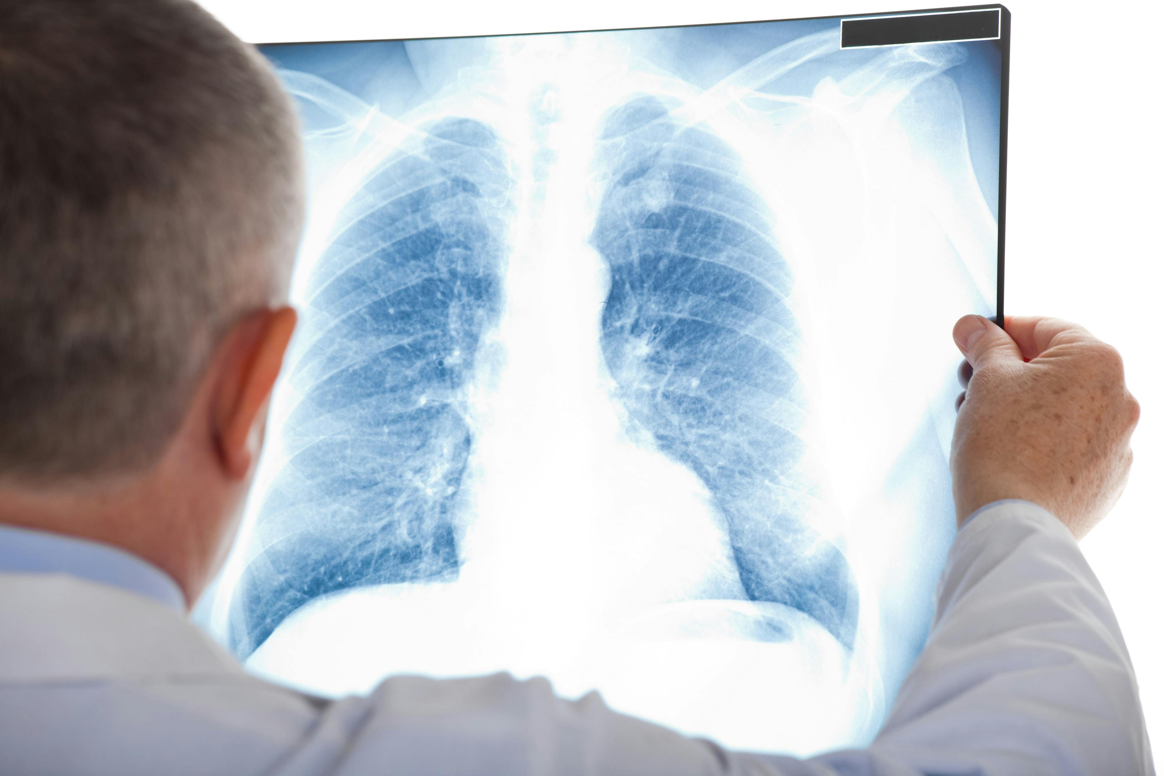 Doctor examining a lung radiography - Image credit: Minerva Studio | stock.adobe.com