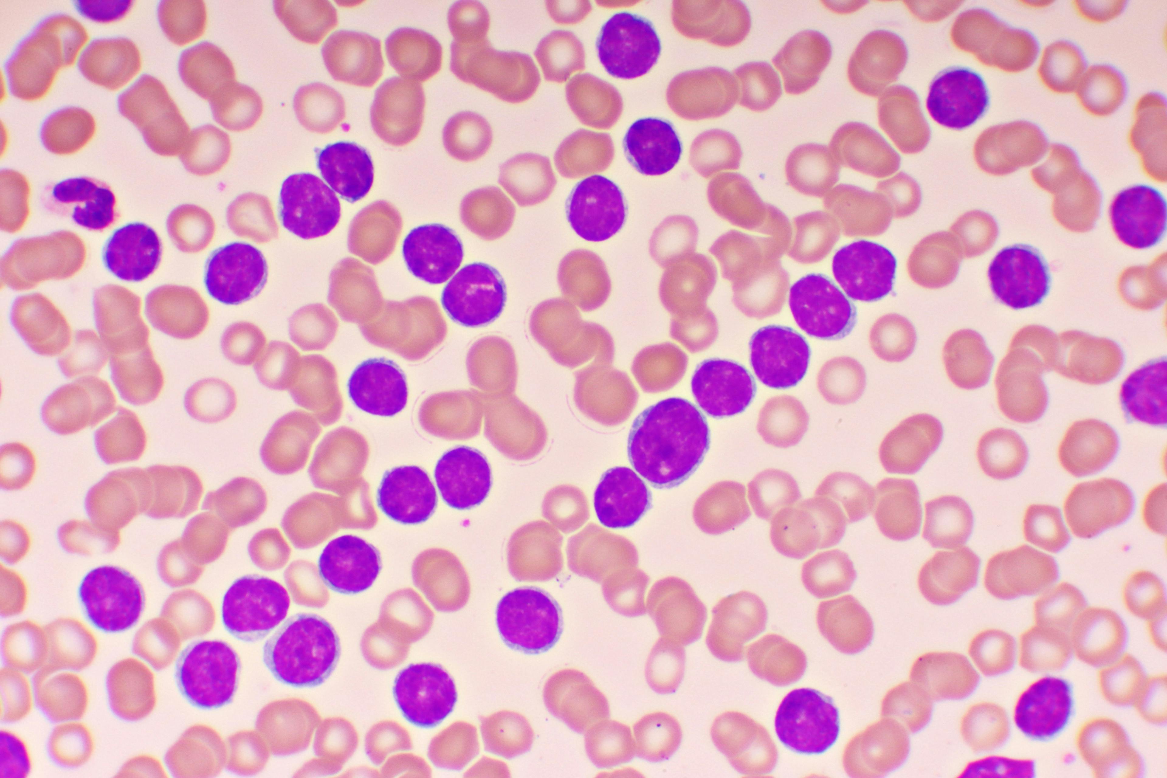 Microscopic view of chronic lymphocytic leukemia, CLL, cells in blood -- Image credit: jarun011 | stock.adobe.com
