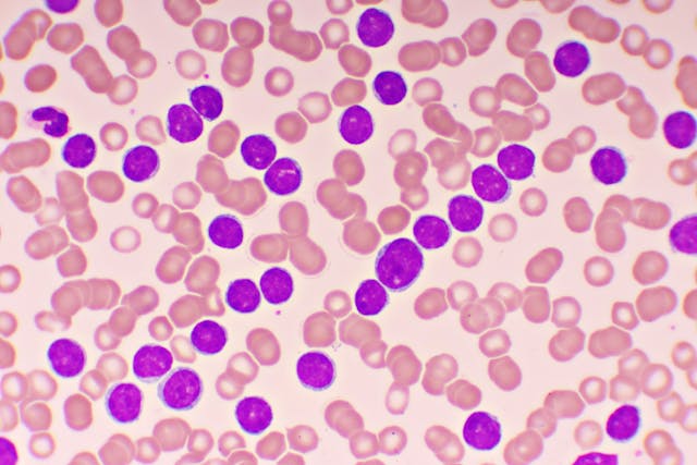 Microscopic view of chronic lymphocytic leukemia, CLL, cells in blood -- Image credit: jarun011 | stock.adobe.com