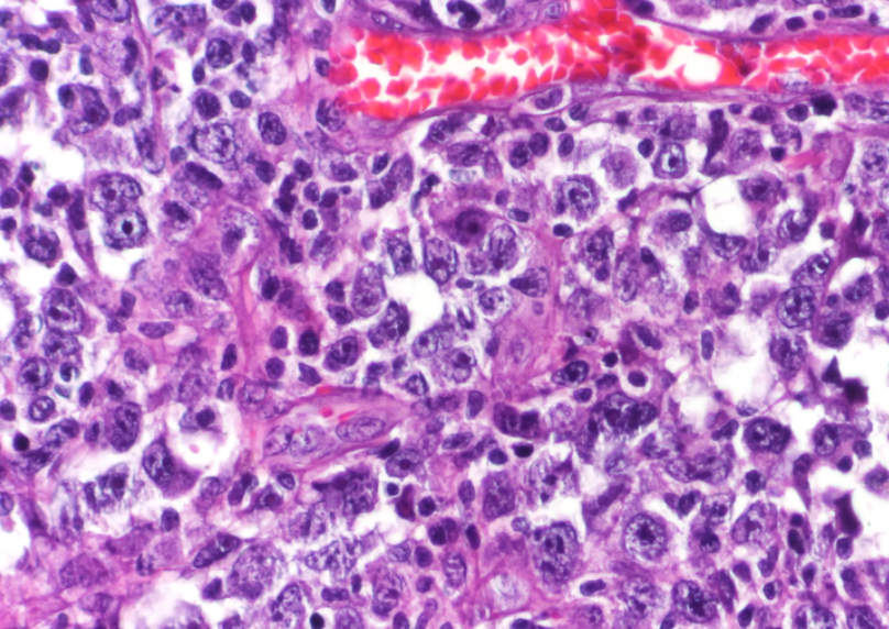 Explore Novel Treatment Modalities for Mantle Cell Lymphoma