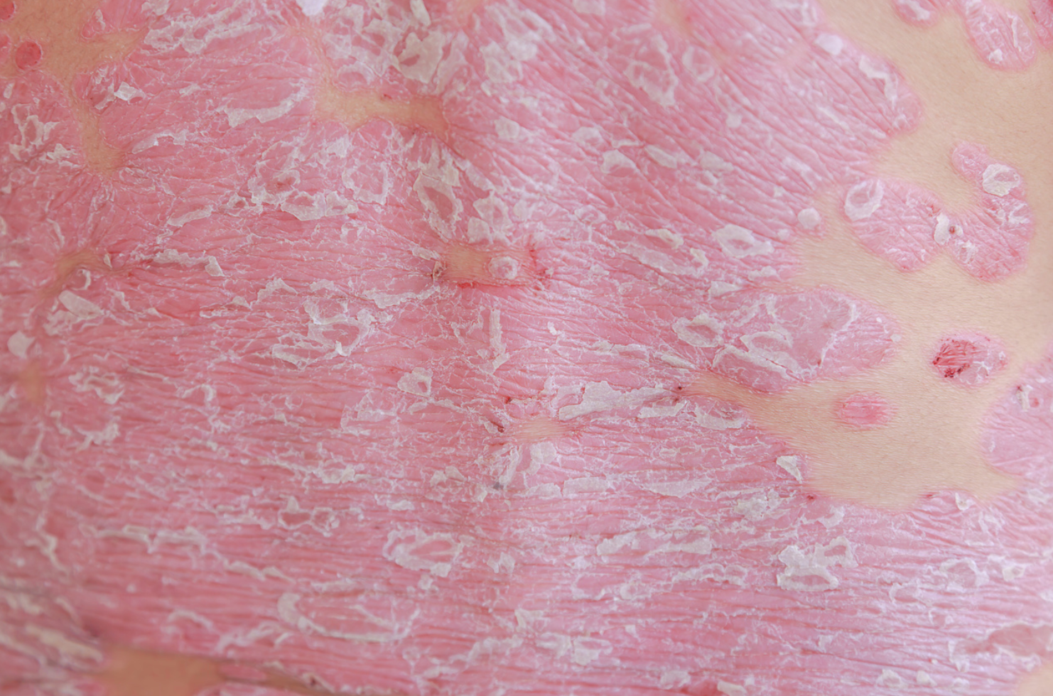 Celiac Disease May Increase the Risk of Developing Psoriasis