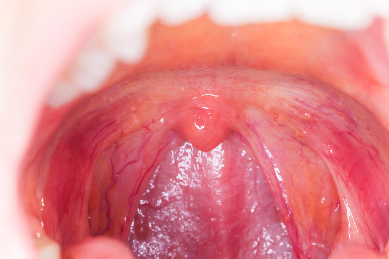 Pharmacy Clinical Pearl of the Day: Tonsillitis