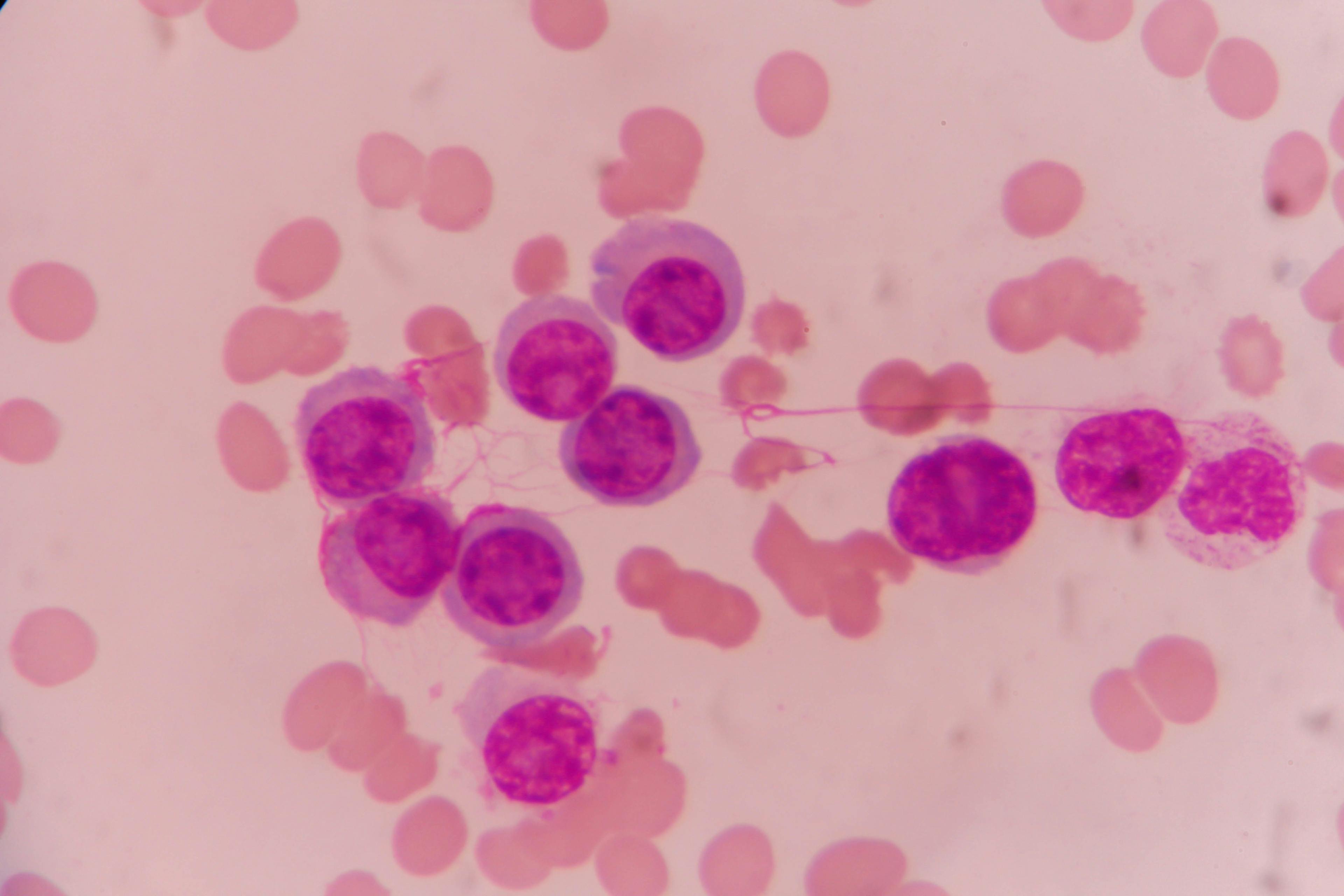 Individuals With Chronic Lymphocytic Leukemia Benefit More From iFCR Therapy Than Older Individuals