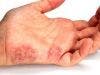 Research May Identify Psoriasis Patients at Risk for Psoriatic Arthritis