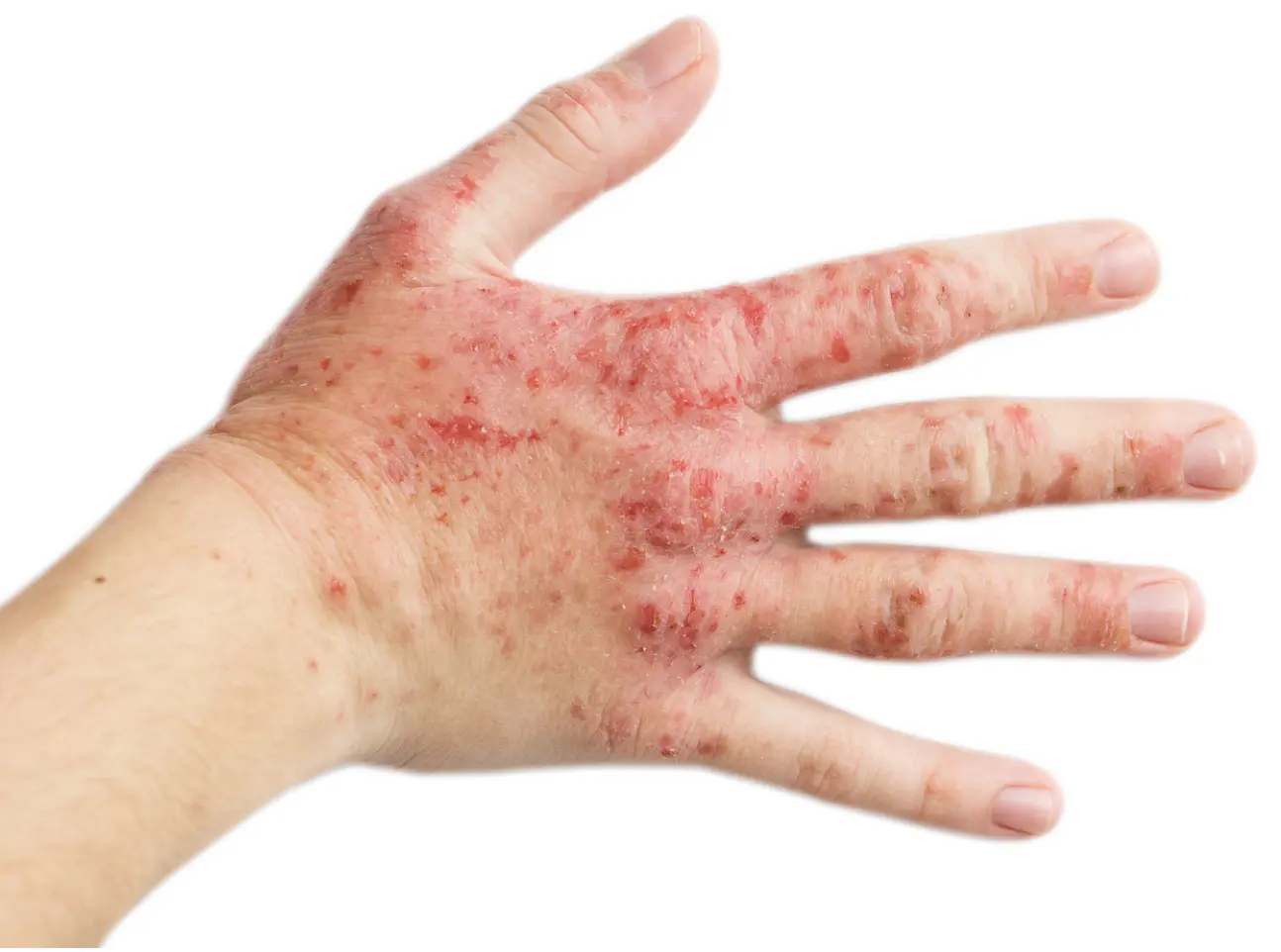FDA Approves Opzelura as Treatment for Atopic Dermatitis