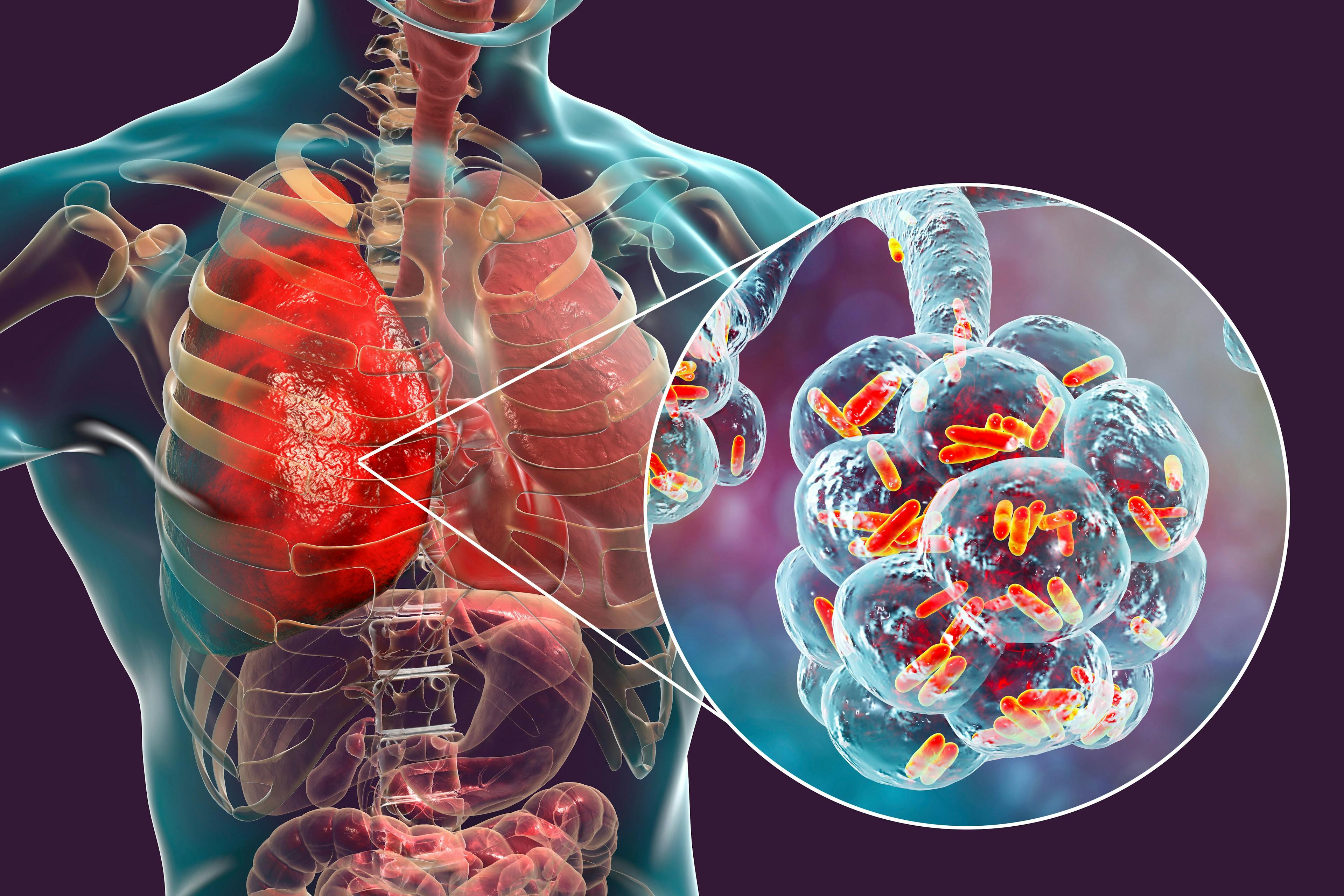 Bacterial pneumonia, medical concept. 3D illustration showing rod-shaped bacteria inside alveoli of the lung | Image Credit: Dr_Microbe - atock.adobe.com