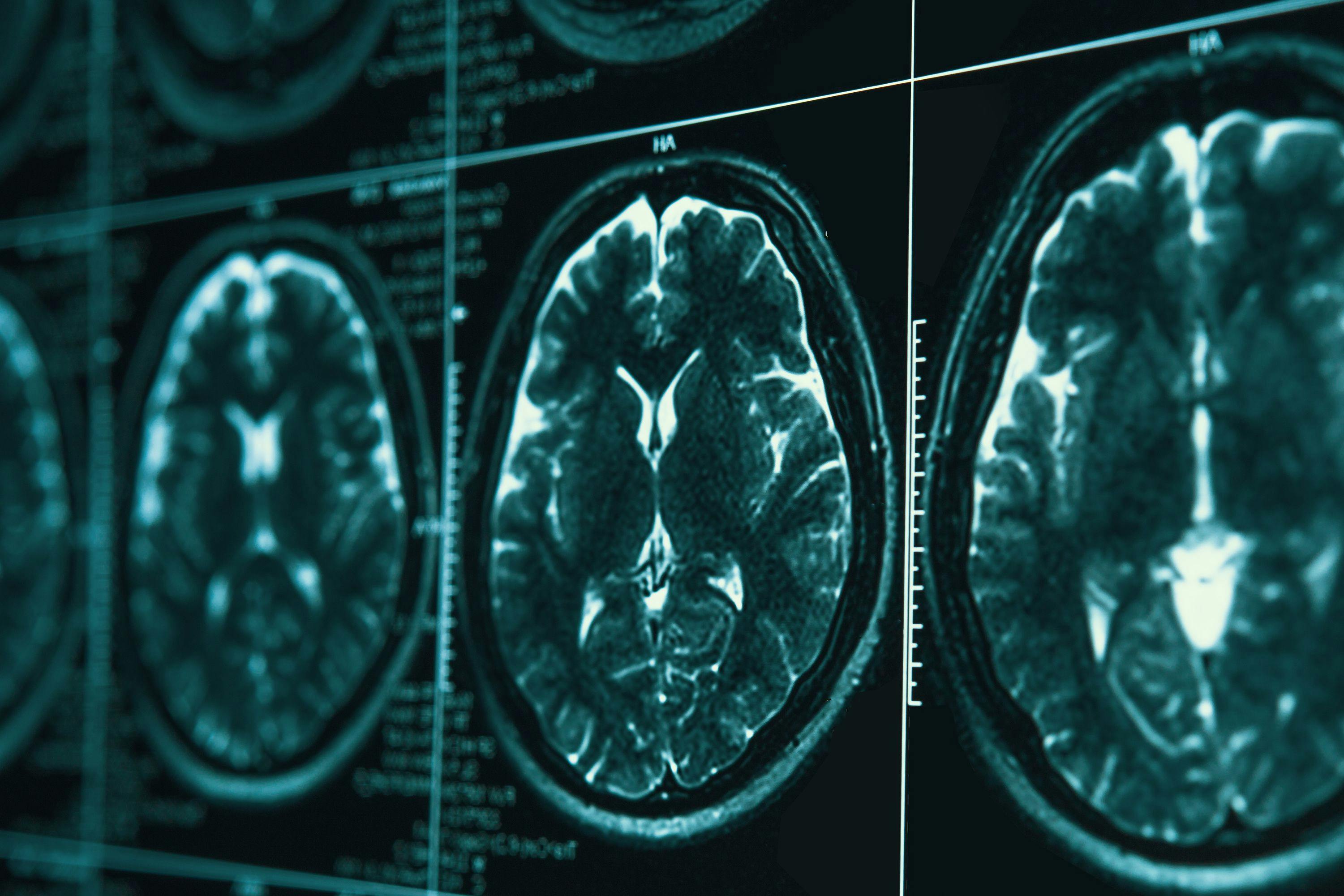 MRI or magnetic resonance image of head and brain scan | Image Credit: DedMityay - stock.adobe.com