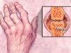 Mechanisms of Rheumatoid Arthritis-Associated Interstitial Lung Disease