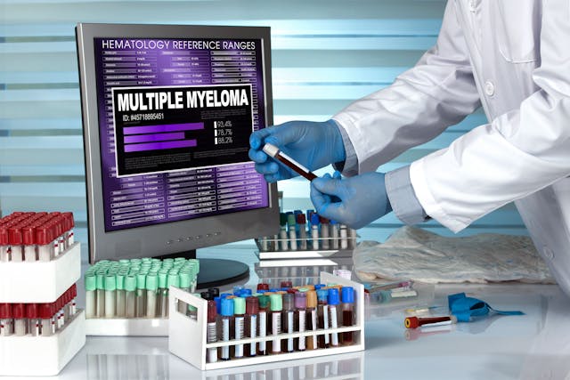 Blood sample positive for multiple myeloma -- Image credit: angellodeco | stock.adobe.com