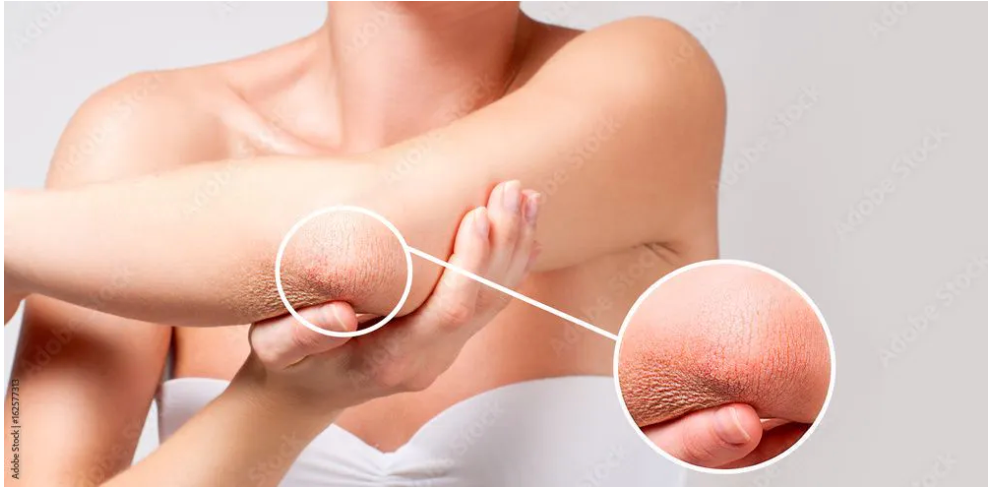 Body care. Woman has dry skin on elbow. - Image credit: Dmytro Flisak | stock.adobe.com