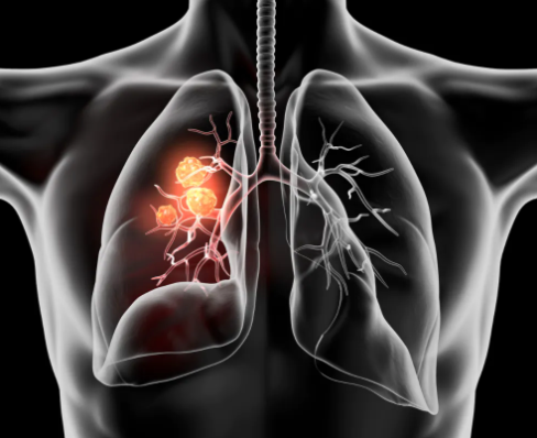 With Perioperative Pembrolizumab, Event-Free Survival for Early-Stage Lung Cancer Was 62% at the Interim Analysis of Phase 3 KEYNOTE-671 