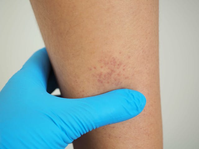 Patient with thrombocytopenia -- Image credit: Bungon | stock.adobe.com 