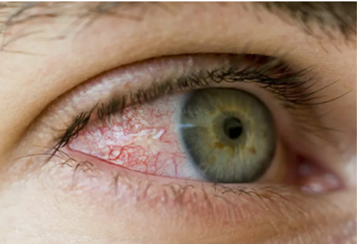 Diabetic Macular Edema Is Treatable, but Prevention Is Best