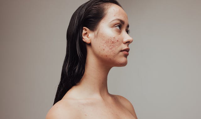 Stress and depression due to skin problems - Image credit: Jacob Lund | stock.adobe.com