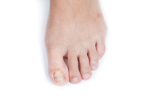Efinaconazole Approved by FDA for Treatment of Onychomycosis in Children