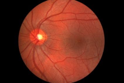 Routine Eye Scanning Can Detect Cognitive Decline in Patients With Diabetes