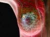 Pertuzumab Granted Priority Review for Adjuvant Treatment of Early Breast Cancer