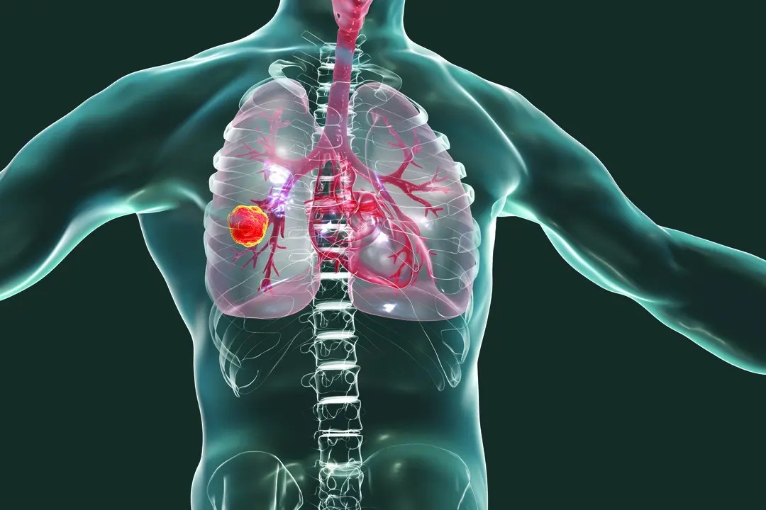 New AI Program Identifies Lung Cancer