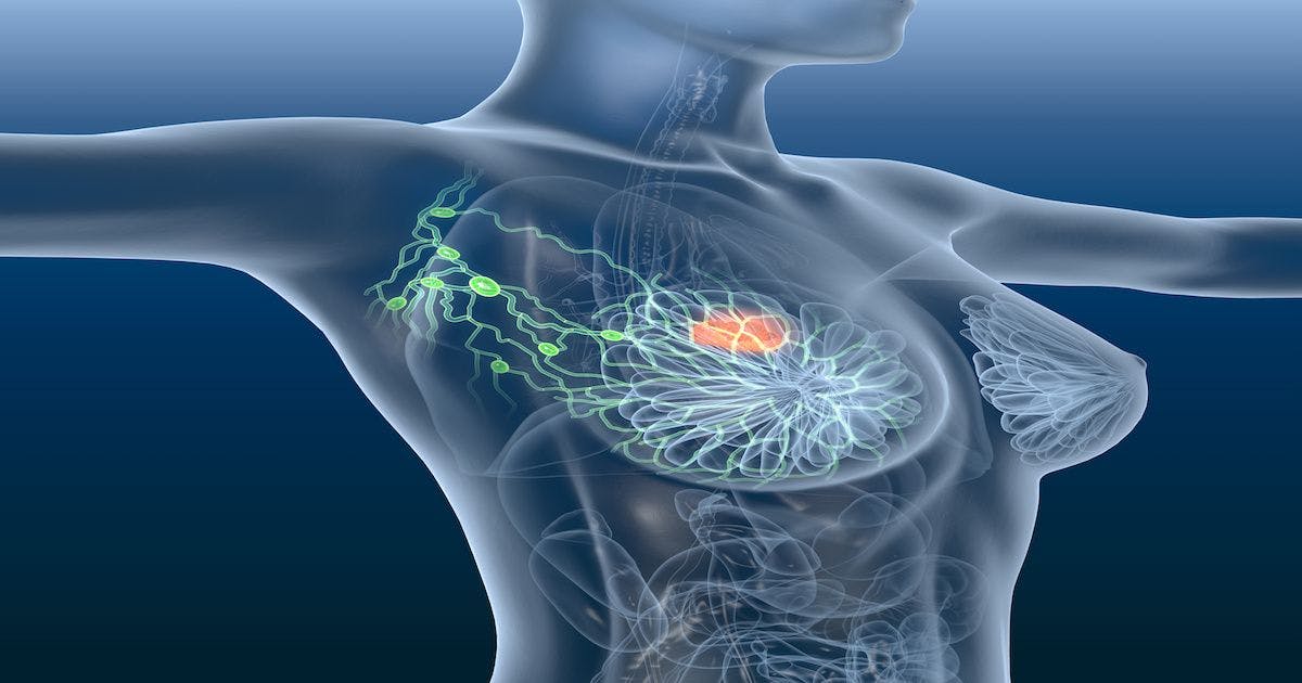 Two New Studies Report Significant Benefit With CDK4/6 Inhibitors in Advanced Breast Cancer