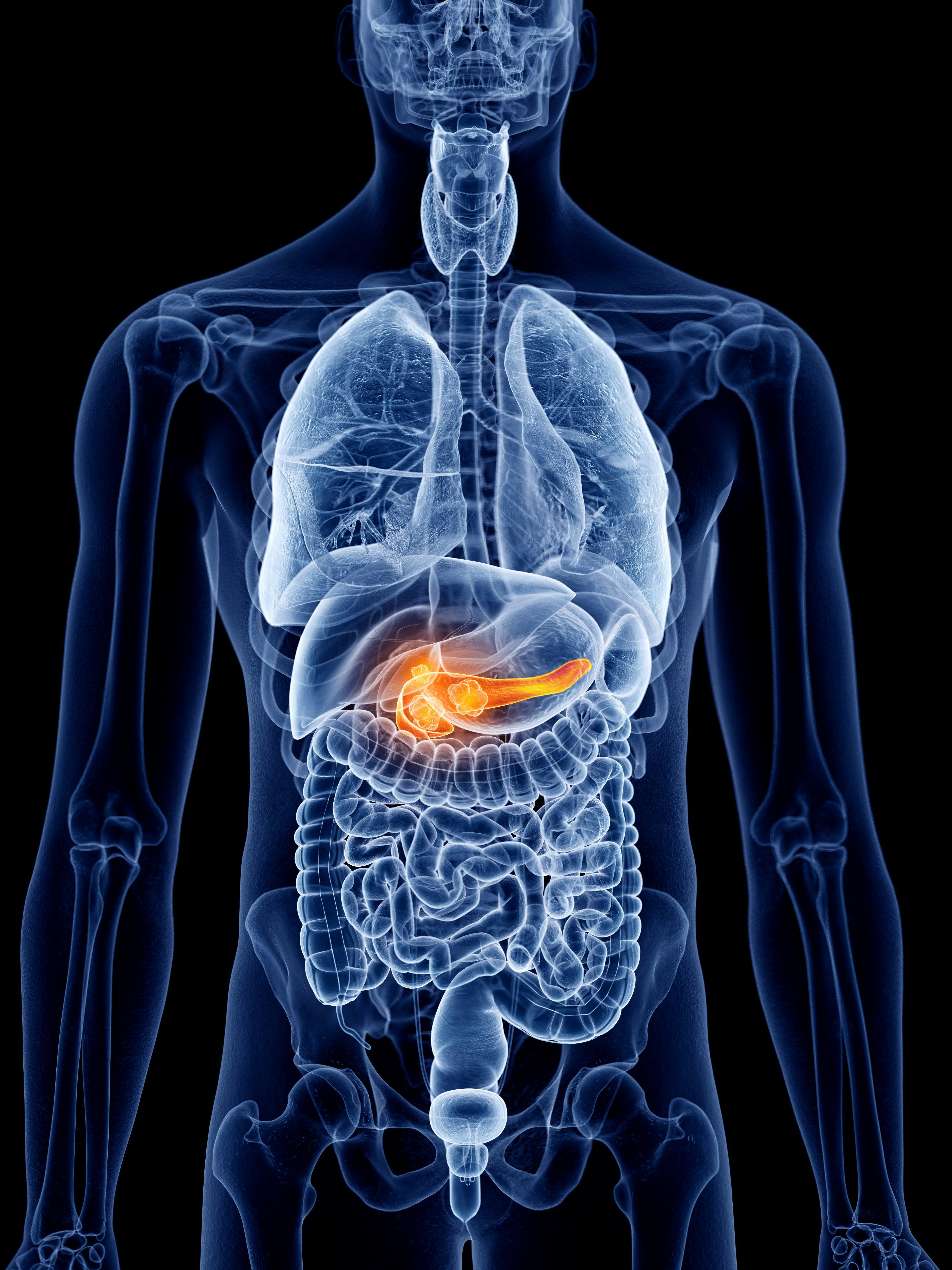 Link Observed Between Opioid Use and Pancreatic Cancer