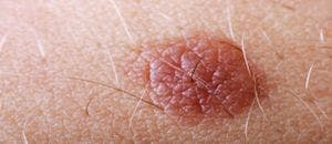 New Skin Cancer Treatments Show Promise