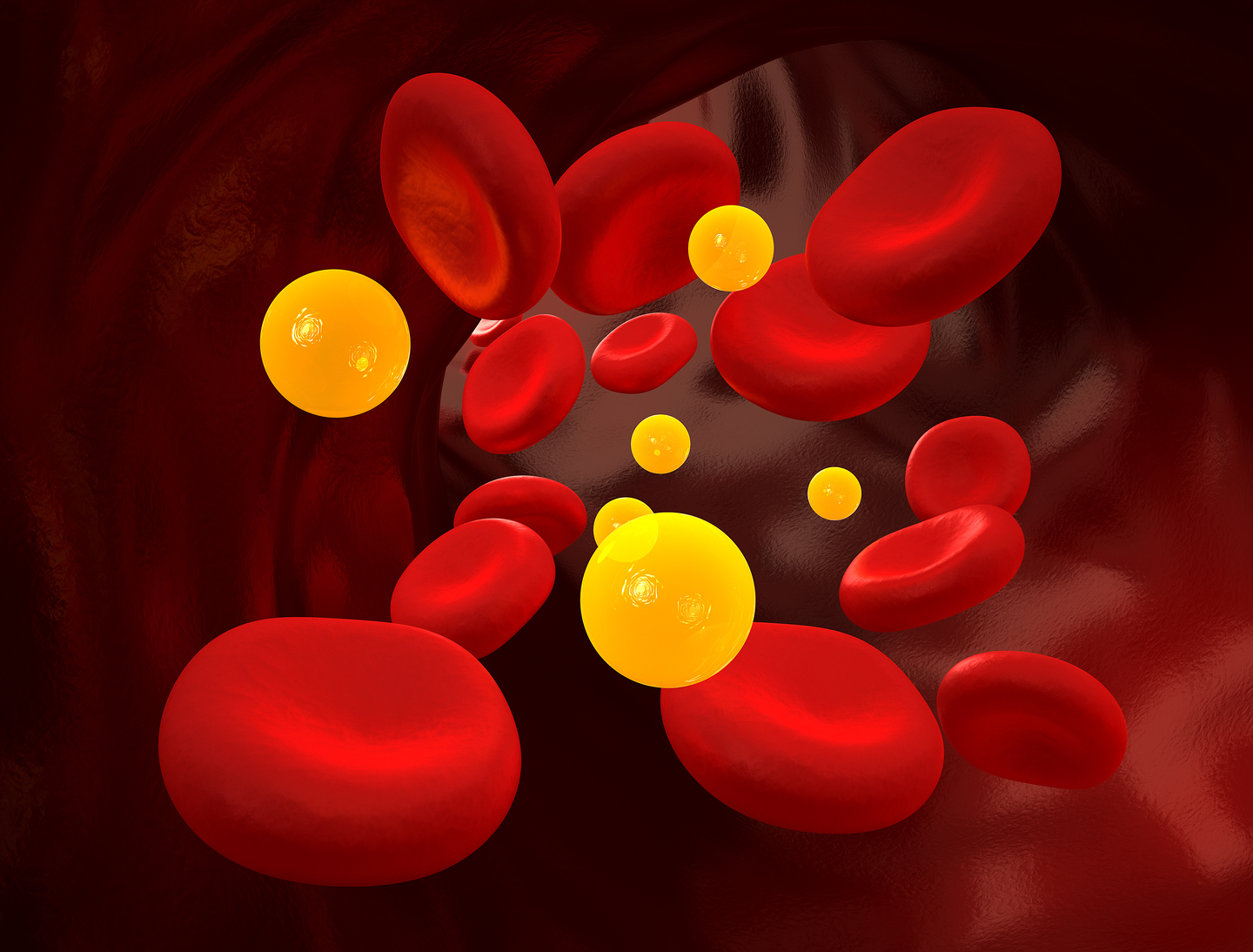 Inclisiran Found to Be Well-tolerated and Effective for Hyperlipidemia in Adults