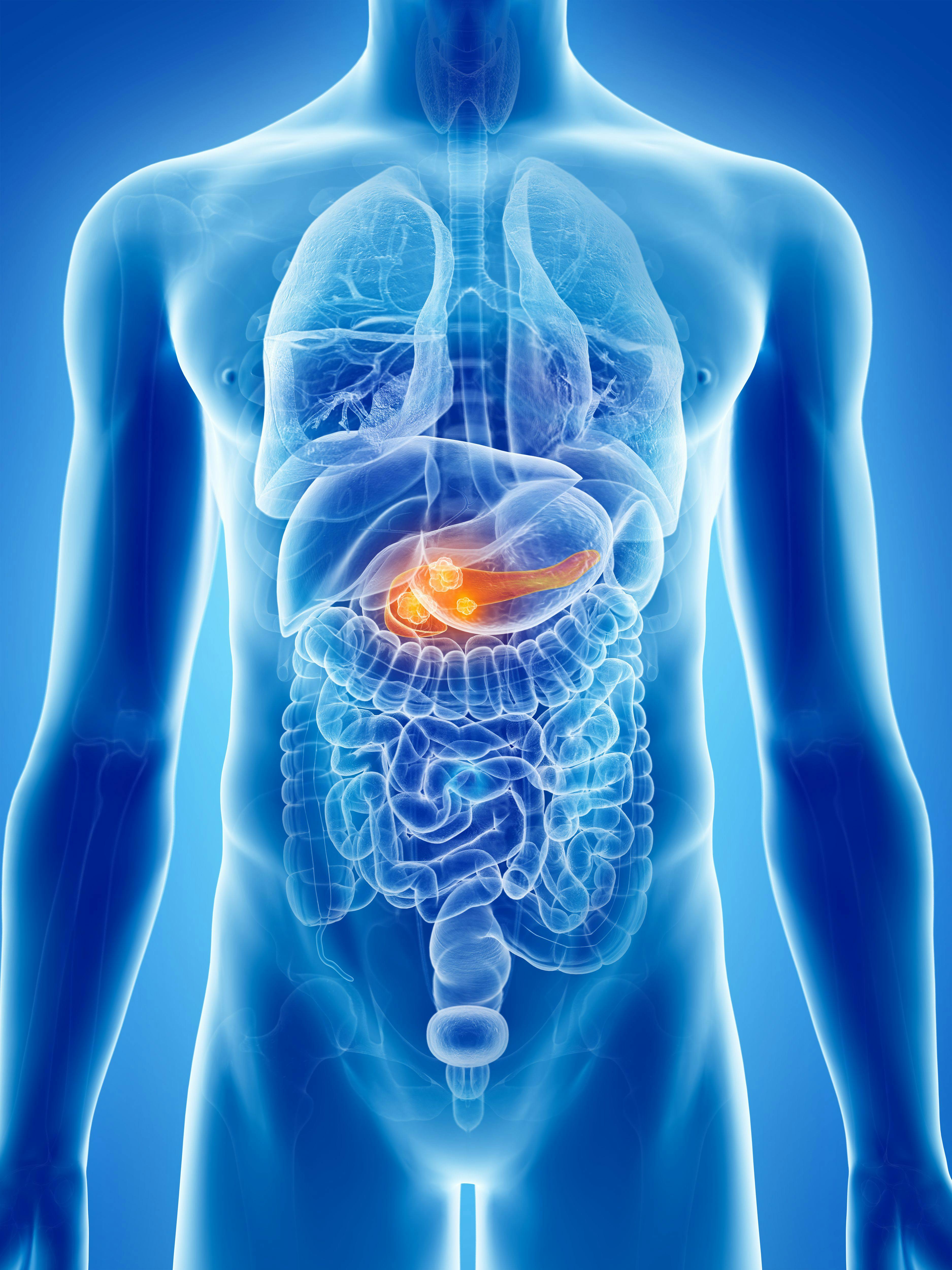 Efficacy and Safety of FOLFIRI for Previously Treated Advanced Pancreatic Cancer