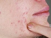 Generic Drug Launched for Severe Acne