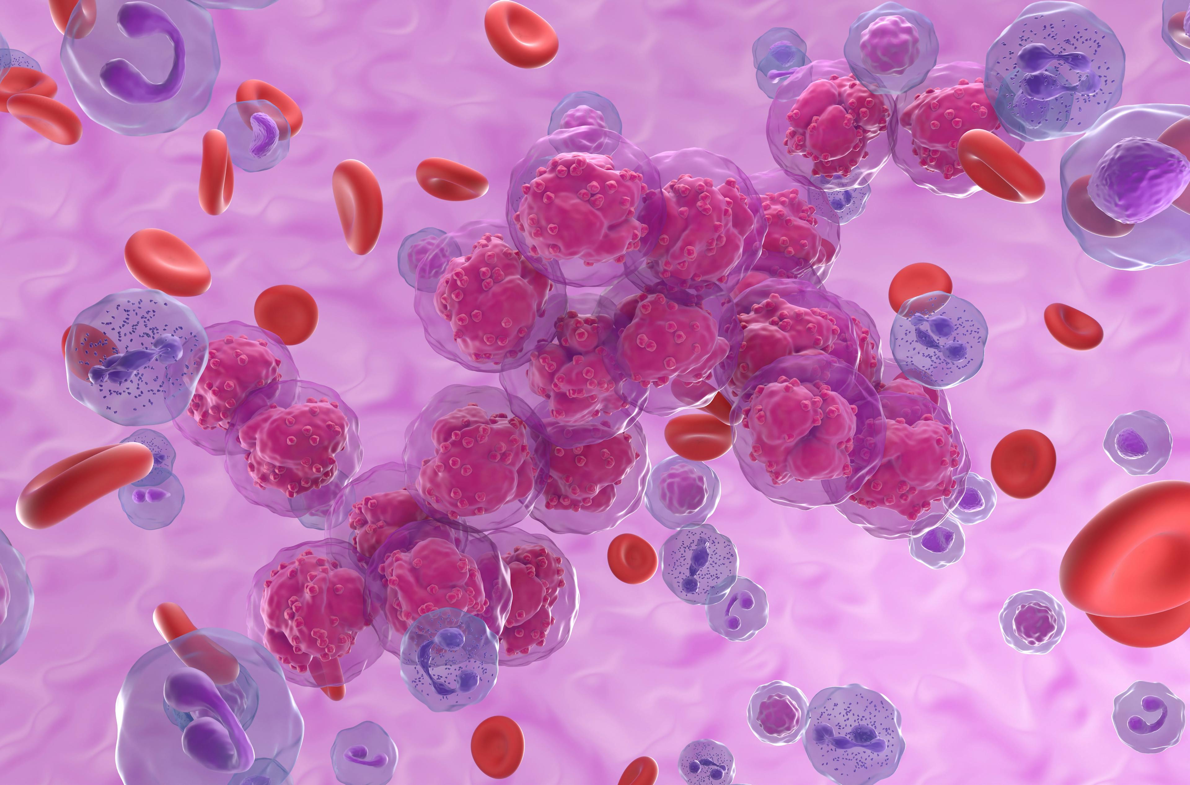 Acute lymphoblastic leukemia (ALL) cancer cell clusters in the blood flow - isometric view 3d illustration | Image Credit: LASZLO - stock.adobe.com