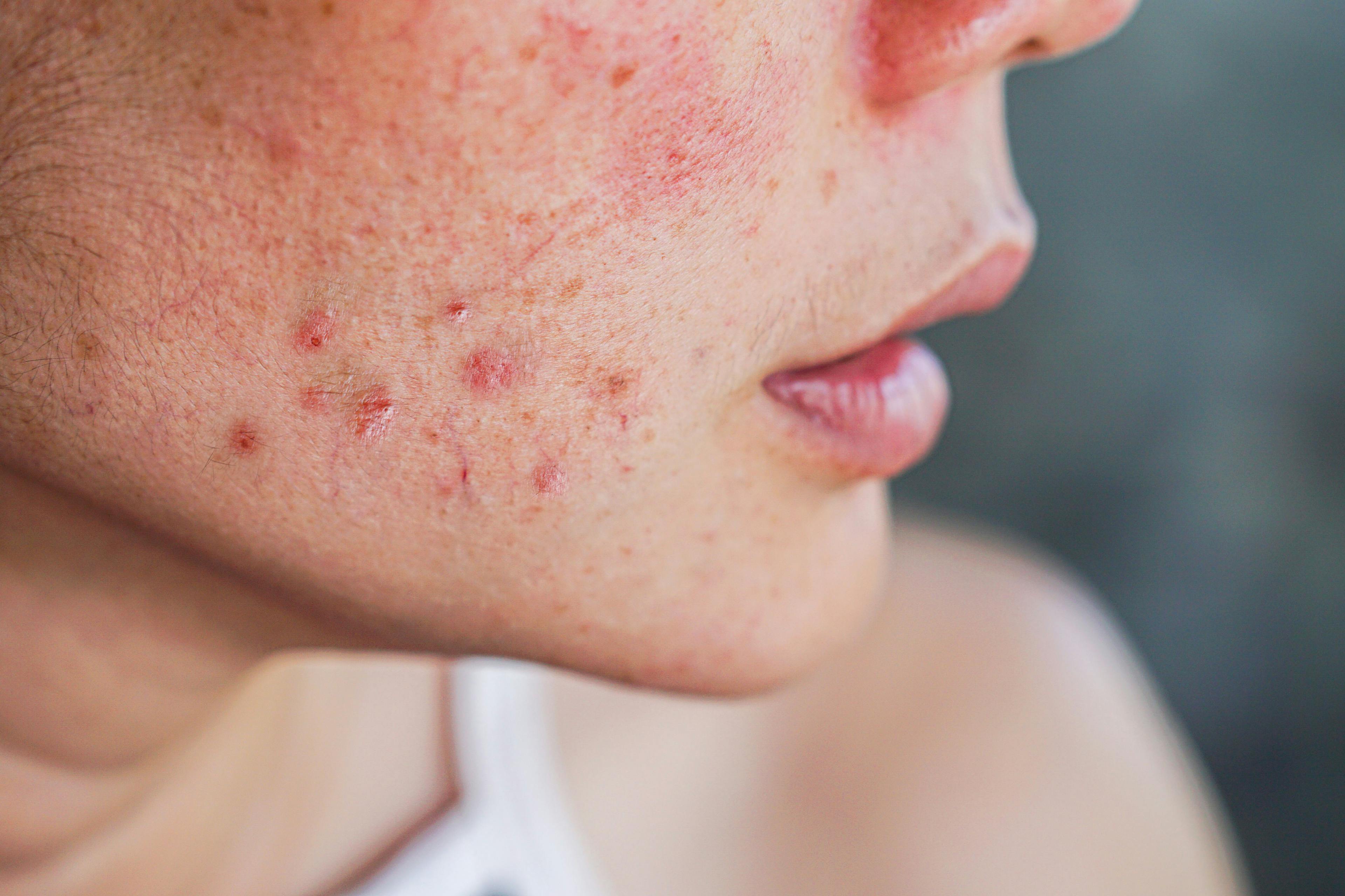 Closeup acne on woman's face with rash skin ,scar and spot that allergic to cosmetics - Image credit: Doucefleur | stock.adobe.com