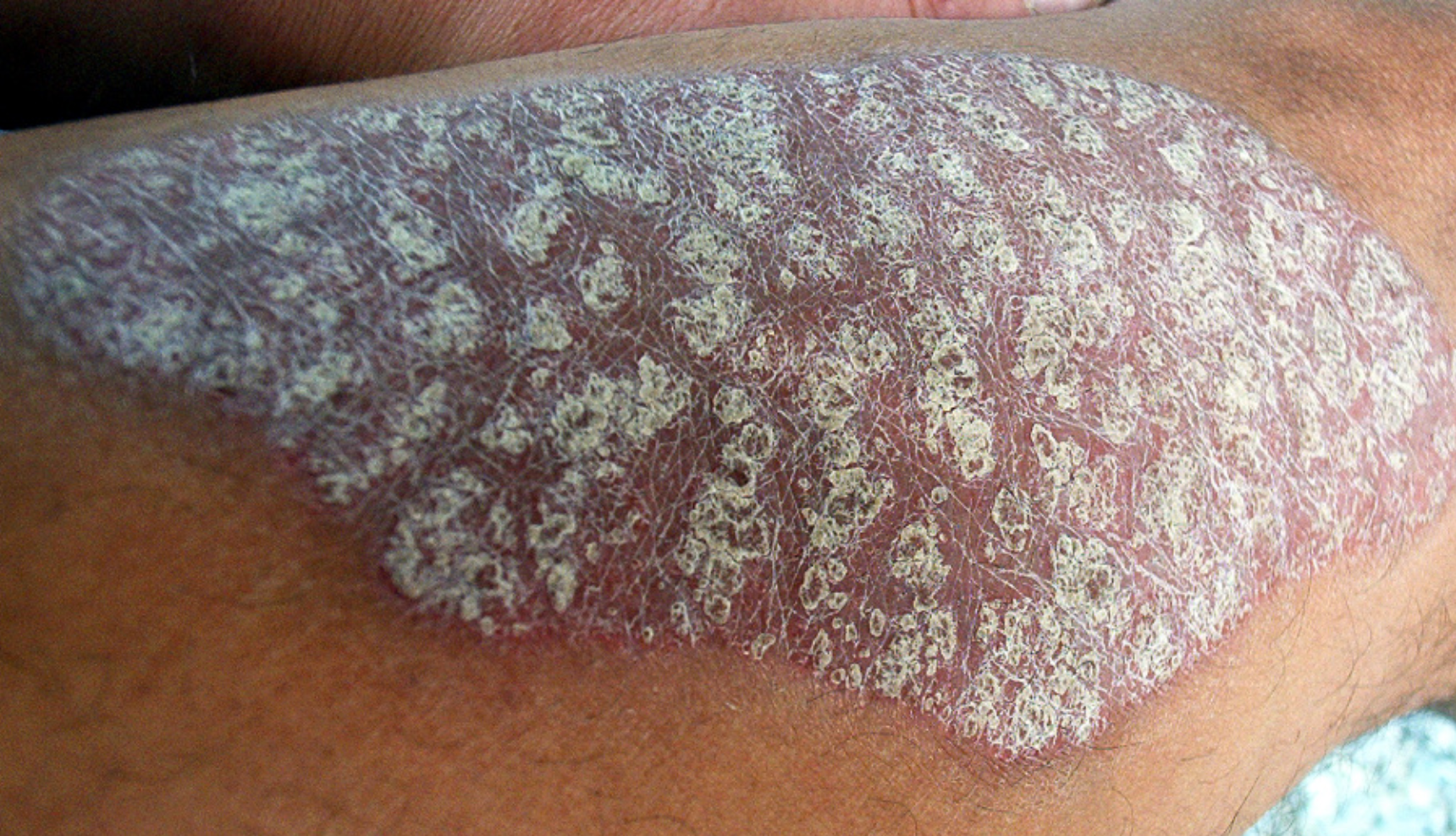 Pharmacy Quiz: Test Your Knowledge on Psoriasis