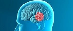 Symptoms of Parkinson's Alleviated by Low-Frequency Stimulation