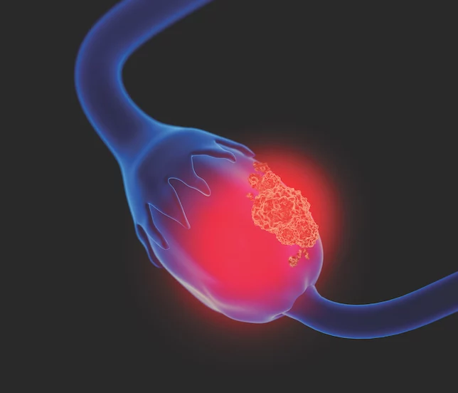 FDA Grants Fast Track Designation to Nemvaleukin as Treatment for Ovarian Cancer