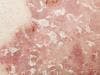 Psoriasis Biosimilar Comparable to Reference Product