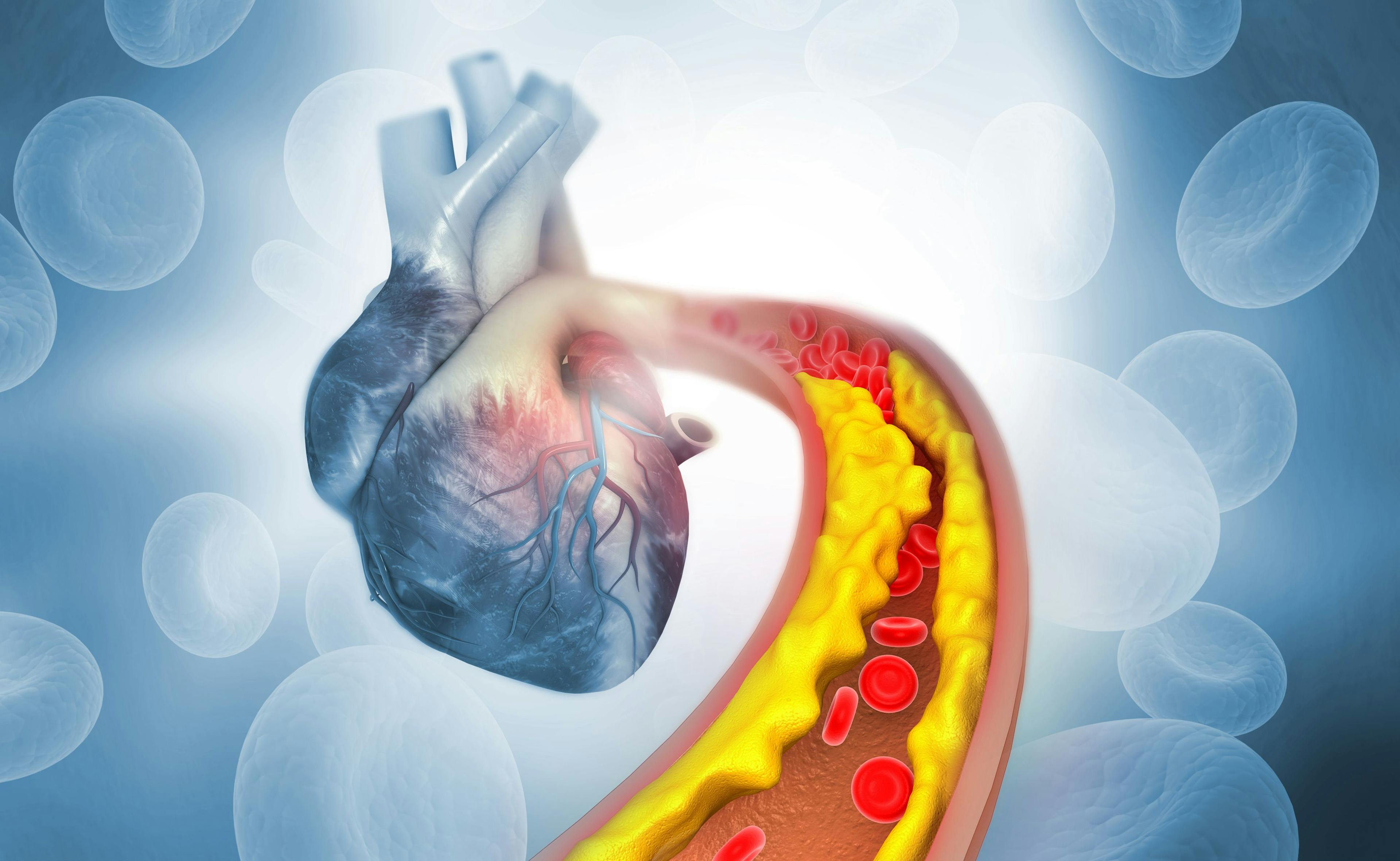 Cholesterol plaque in artery with Human heart anatomy | Image Credit: Rasi - stock.adobe.com