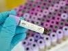 Natural Antibodies May Boost Development of HIV Vaccine
